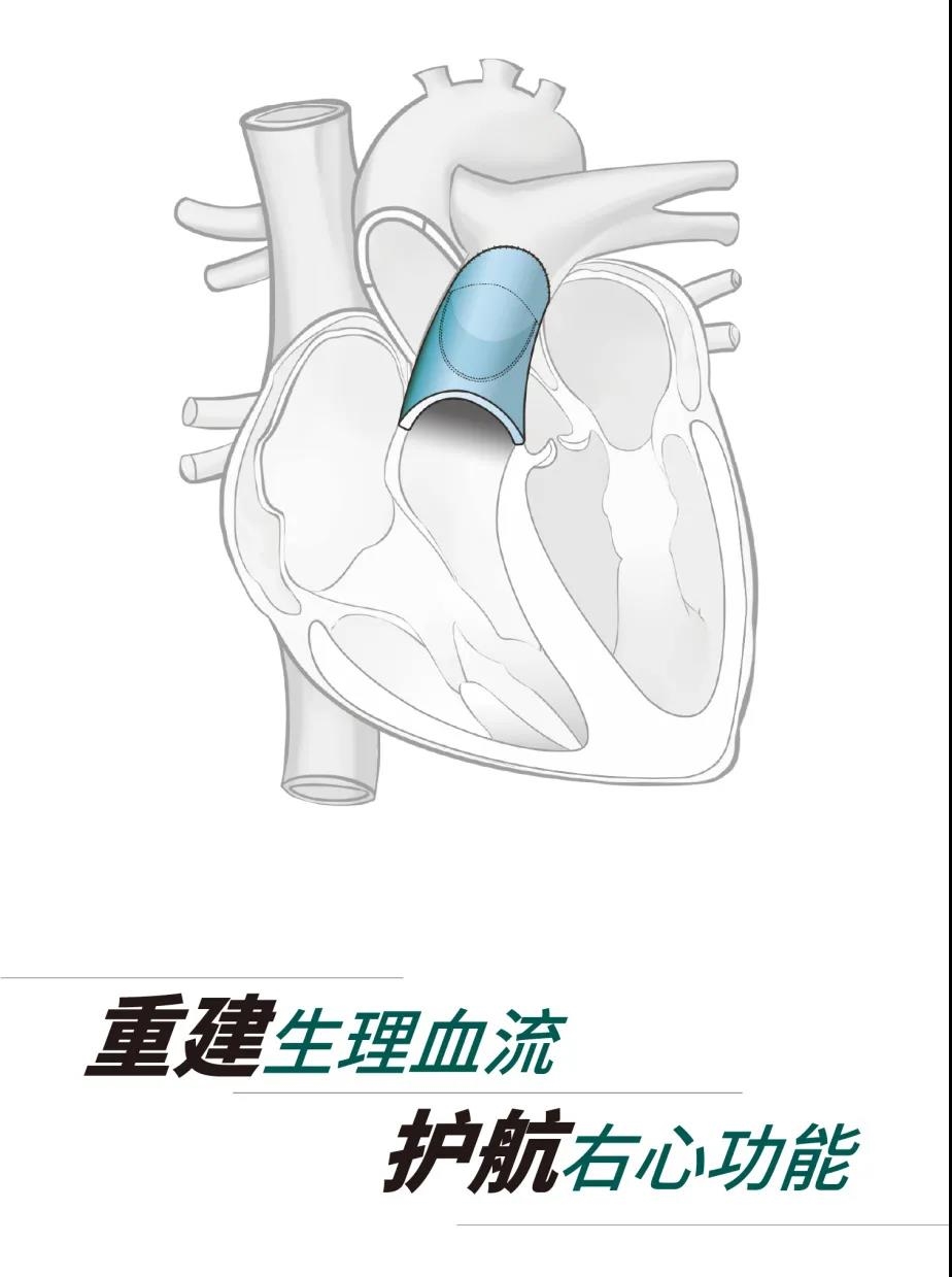 【首創】Balmonoc TM流出道單瓣補片獲批上市
