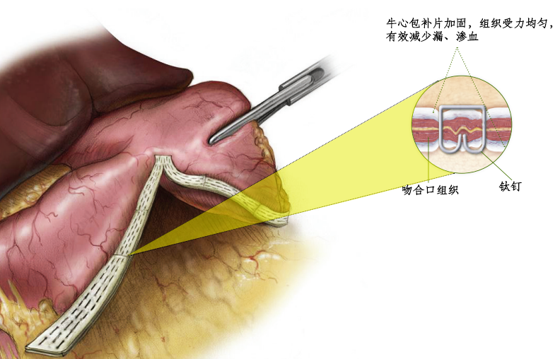 防滲漏，促愈合-佰仁醫療消化外科生物補片注冊臨床試驗入組正式完成